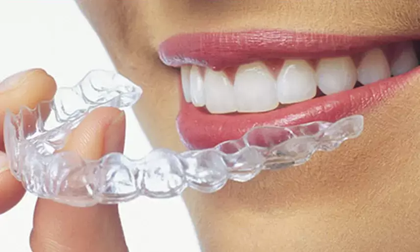 Clear Aligners