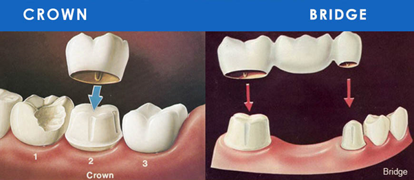 Fillings and Root Canals